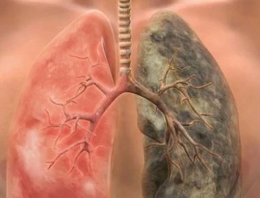 Κάπνισμα: Φτιάξτε «ελιξίριο» καθαρισμού των πνευμόνων σας (φωτό)